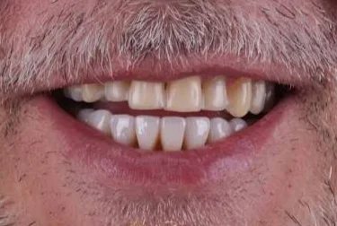 Antes