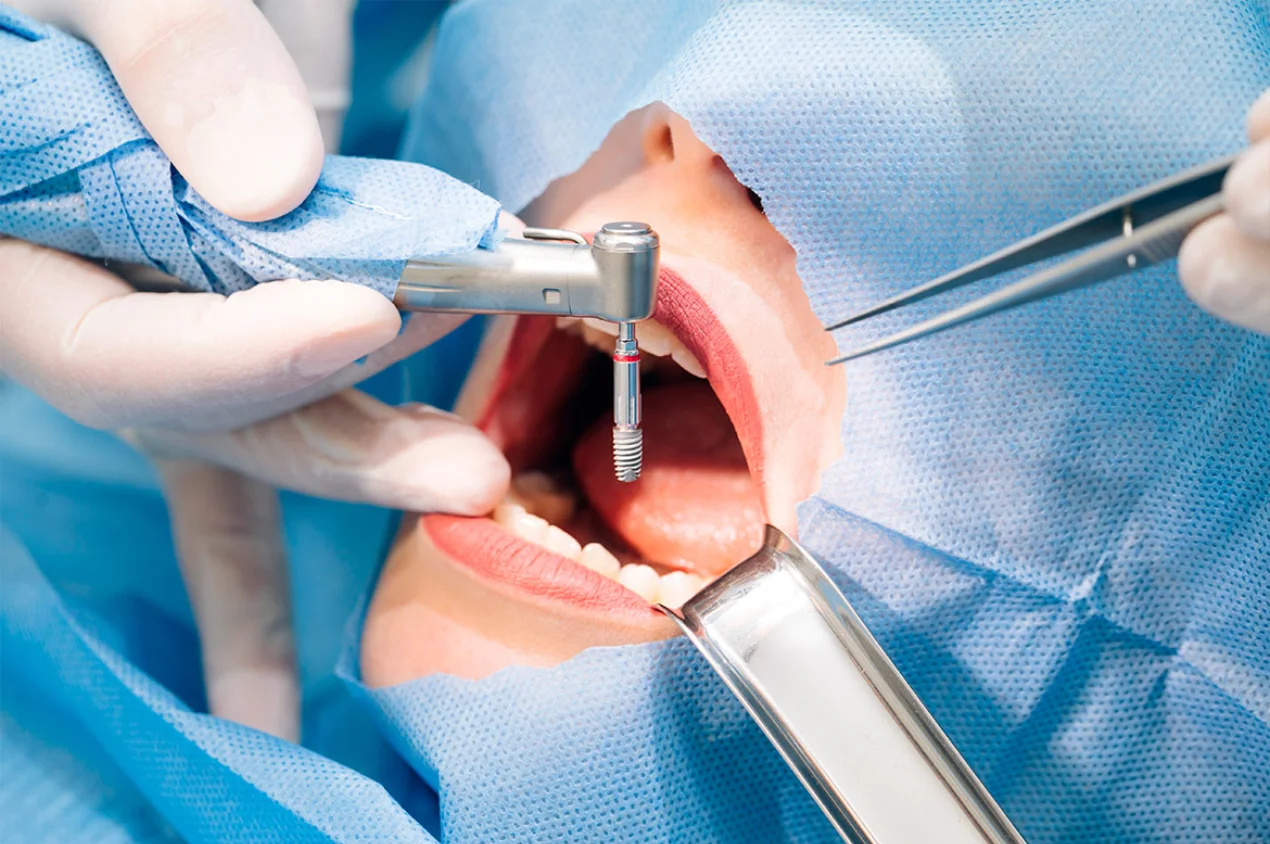 Cirurgia Oral